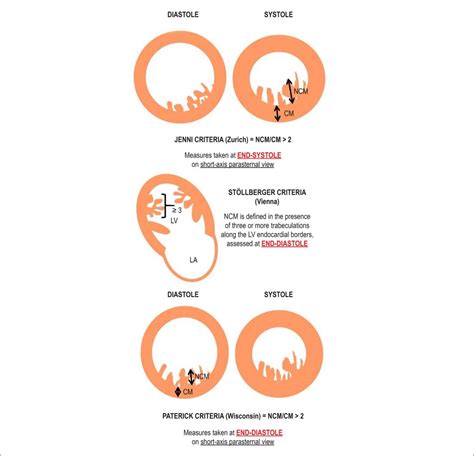 noncompaction cardiomyopathy diagnosis